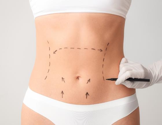Abdominoplasti