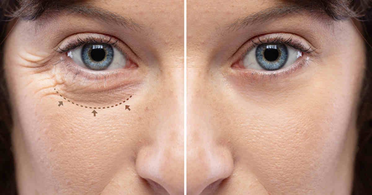 Blepharoplasty-in-Turkey