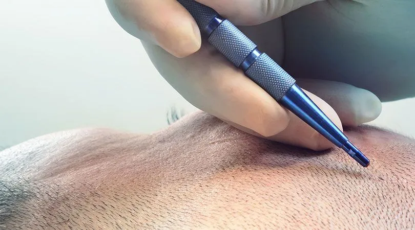 Saphir-Haartransplantation