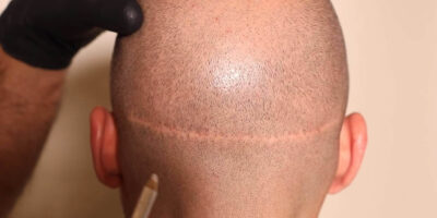 fut-haartransplantation-narbe