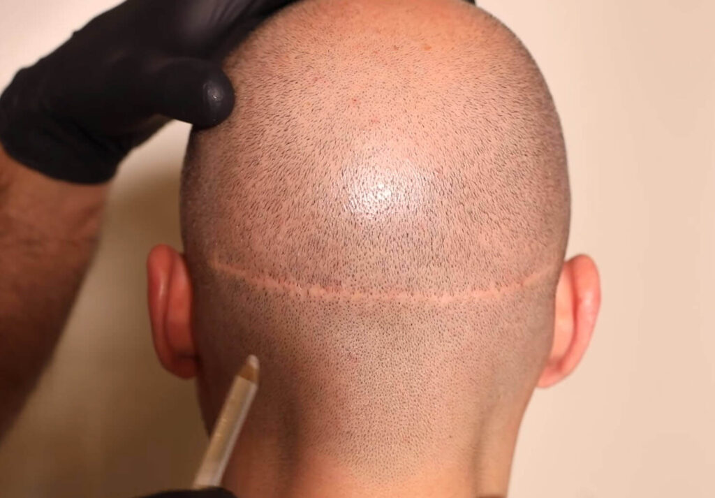 fut-haartransplantation-narbe