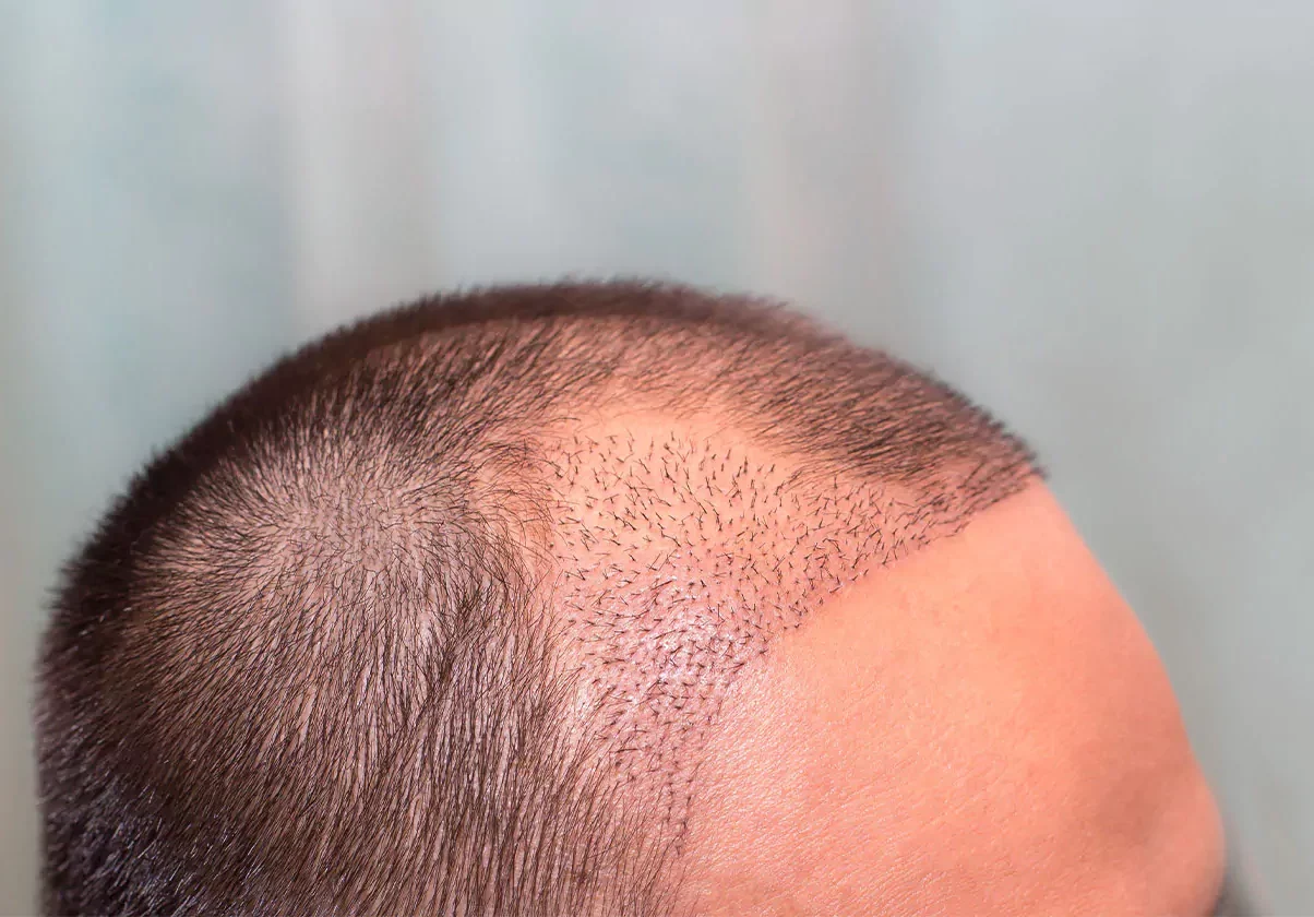 nach-der-haartransplantation-in-frankfurt