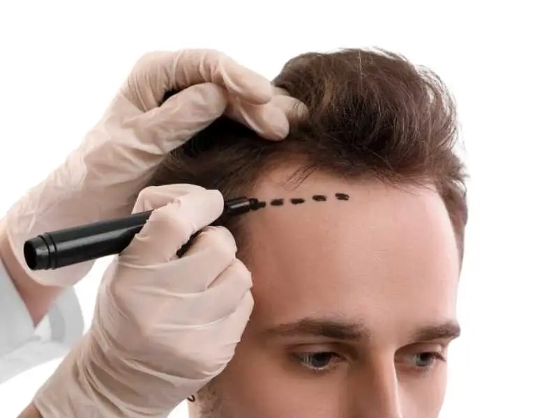was-ist-eine-dhi-haartransplantation-1
